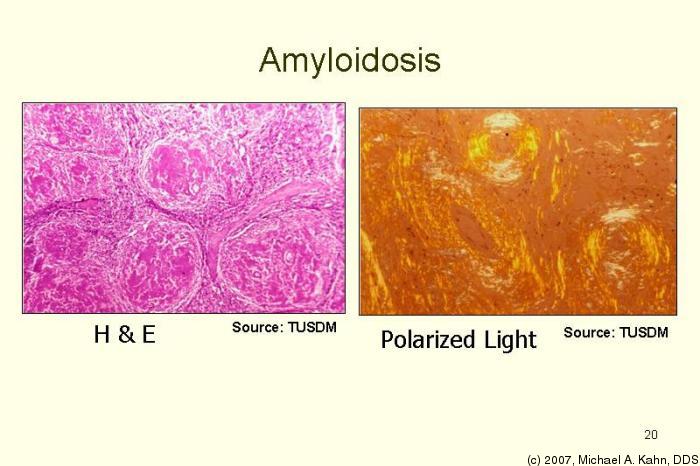 amyloidosis