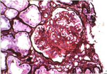 重度系膜增生 重度系膜增生
